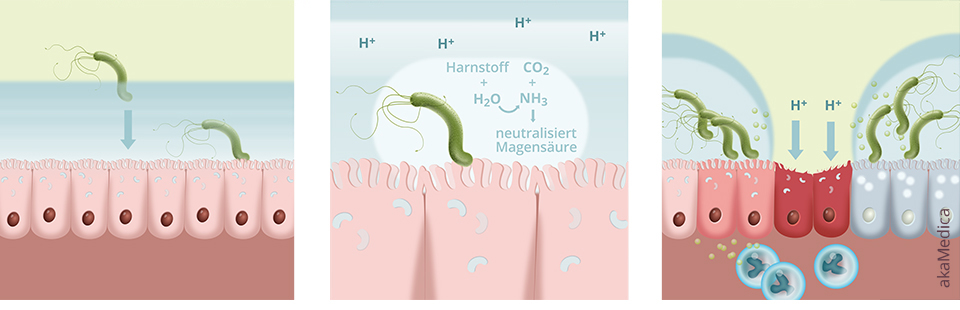 Infografik Helicobacter